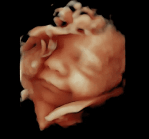 3D ultrasound — fetal face